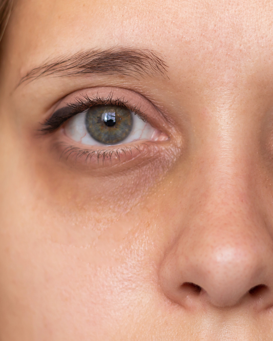 Understanding and Managing Dark Circles Under the Eyes